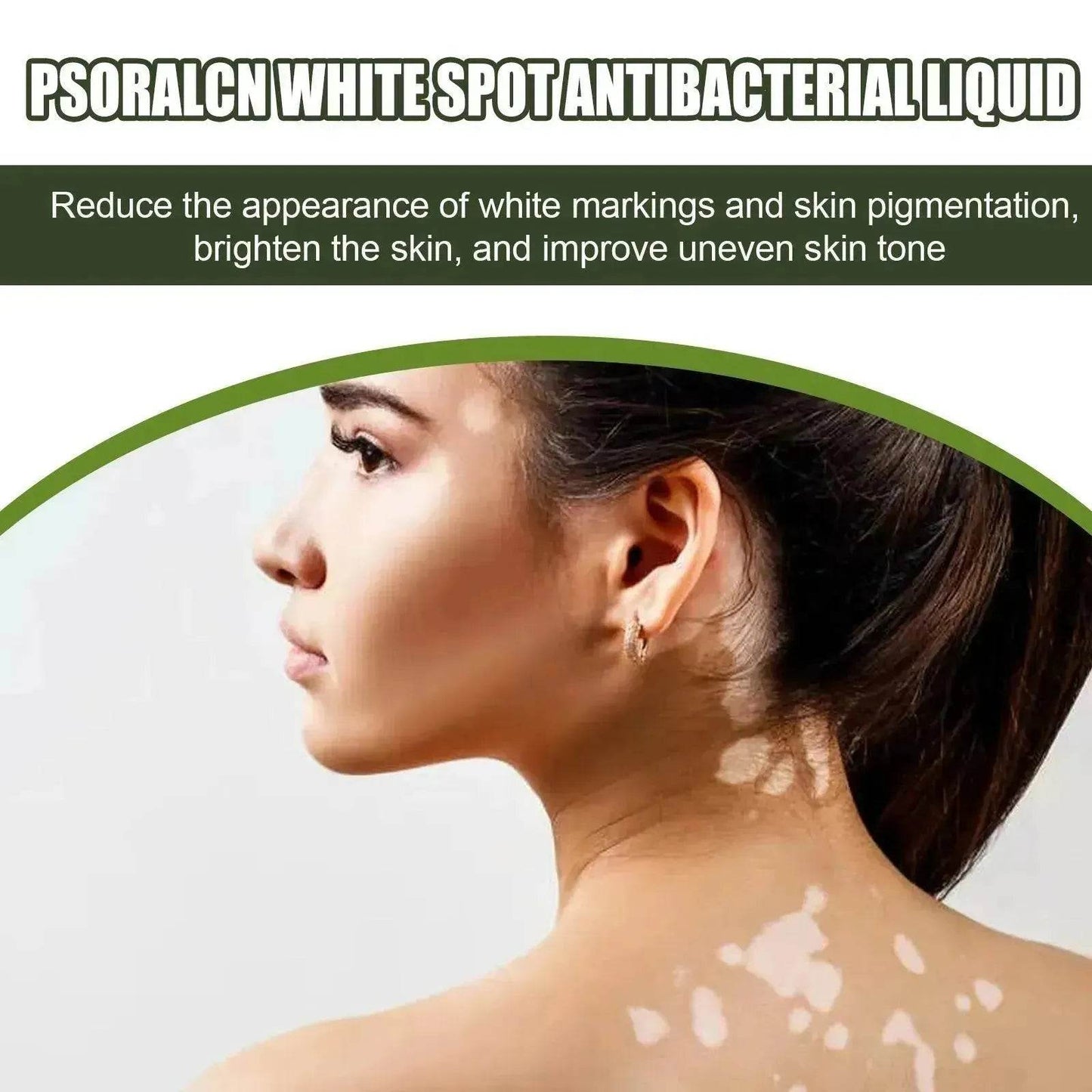 EELHOE White Spot Cleansing Serum PSORALCN White Spot Antibacterial Liquid.