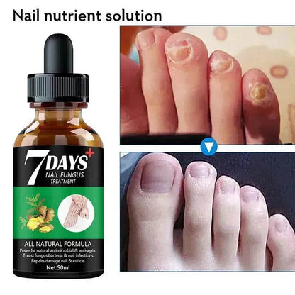 7DAYS Nail Fungus Treatment Serum Care Hand And Foot Care Removal