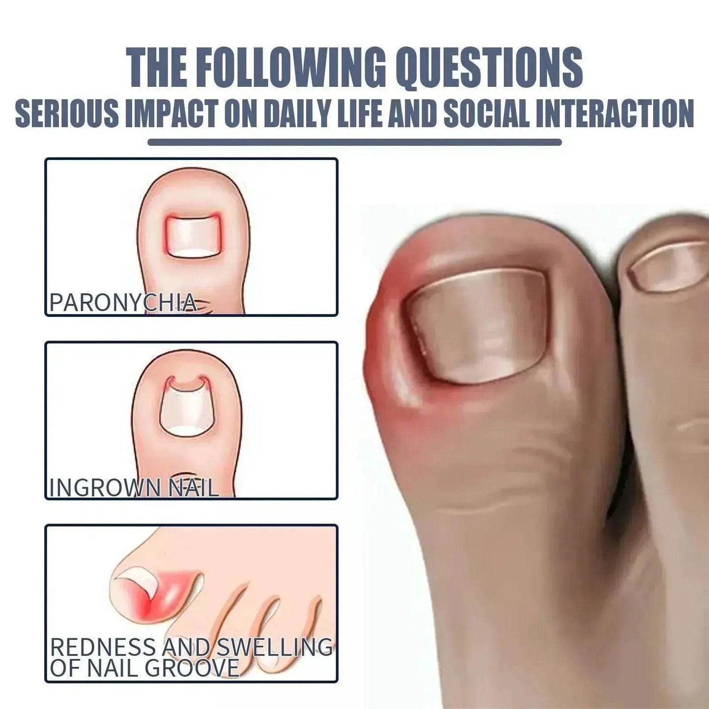 Relieving And Repairing Ingrown Nail Toe Nail Removing Meat Treatment Oil