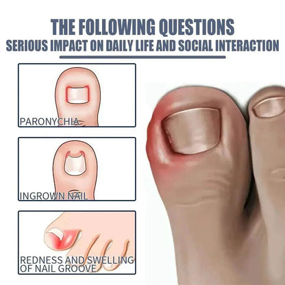 Relieving And Repairing Ingrown Nail Toe Nail Removing Meat Treatment Oil