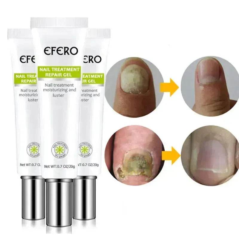 Sérum de Traitement des Ongles, Gel Éliminateur de Champignons des Ongles, Crème Réparatrice des Ongles Anti-Infection Onychomycose, Soin des Pieds
